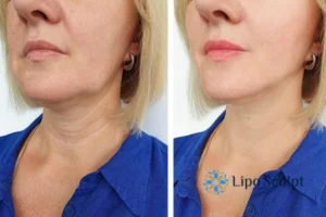 Double chin before and after Hi-Fu treatment 4 Book your double chin treatment Gainsborough today! We are here to help!