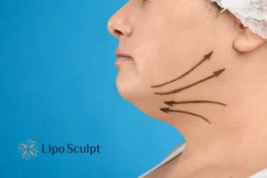 Double chin before and after Hi-Fu treatment 3 Boost your confidence with a Double chin treatment Gainsborough