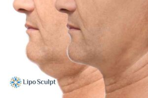 Double chin before and after Hi-Fu treatment 2 Double chin treatment Gainsborough from Lipo Sculpt - feel more confident today!